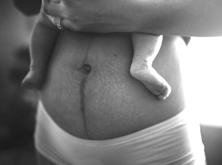 mage efter graviditet med bristningar