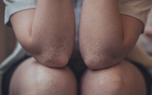 6 tips for å unngå urinveisinfeksjon